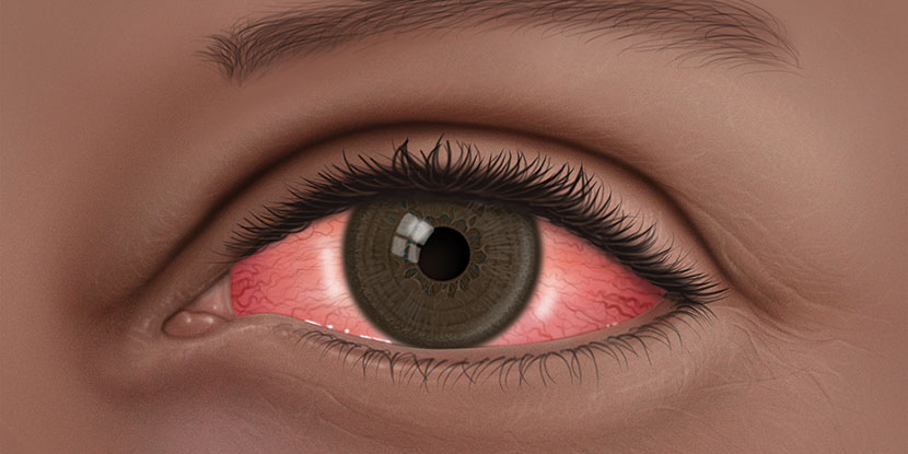 a-case-for-conjunctivitis-reeves-eye-surgery-center